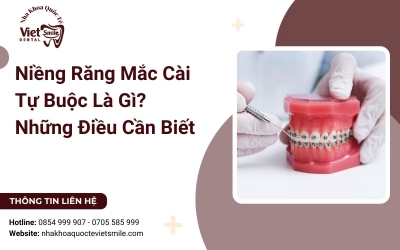 Niềng Răng Mắc Cài Tự Buộc Là Gì? Những Điều Cần Biết