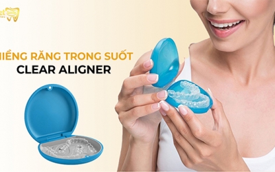 Niềng răng trong suốt Clear Aligner là gì? Ai là người nên sử dụng?