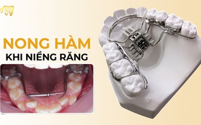 Nong hàm là gì? Khi nào cần nong hàm khi niềng răng