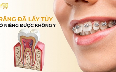 Răng đã lấy tủy có niềng được không? Trường hợp không nên niềng răng