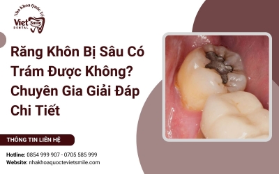 Răng Khôn Bị Sâu Có Trám Được Không? Chuyên Gia Giải Đáp Chi Tiết
