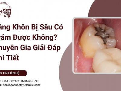 Răng Khôn Bị Sâu Có Trám Được Không? Chuyên Gia Giải Đáp Chi Tiết