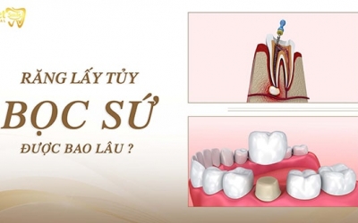 Răng lấy tủy bọc sứ được bao lâu? Răng lấy tủy tồn tại được bao lâu? 