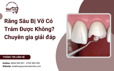 Răng Sâu Bị Vỡ Có Trám Được Không? Chuyên Gia Giải Đáp