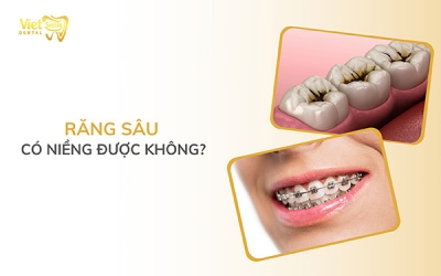 Răng sâu có niềng được không? Có cần trám răng trước khi niềng?