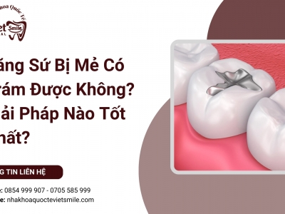 Răng Sứ Bị Mẻ Có Trám Được Không? Giải Pháp Nào Tốt Nhất?