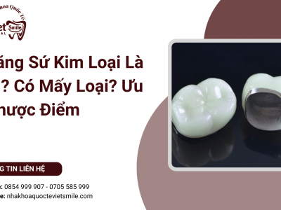 Răng Sứ Kim Loại Là Gì? Có Mấy Loại? Ưu Nhược Điểm