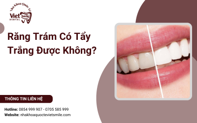 Răng Trám Có Tẩy Trắng Được Không?