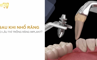 Sau khi nhổ răng bao lâu thì trồng implant?