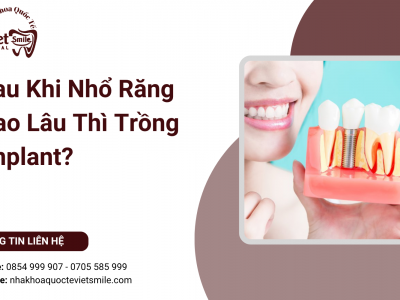 Sau Khi Nhổ Răng Bao Lâu Thì Trồng Implant?