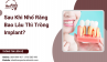 Sau Khi Nhổ Răng Bao Lâu Thì Trồng Implant?