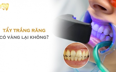 Tẩy trắng răng có bị vàng lại không? Nguyên nhân và cách khắc phục