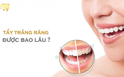 Tẩy trắng răng được bao lâu thì làm lại?