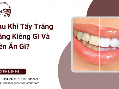 Sau Khi Tẩy Trắng Răng Kiêng Gì Và Nên Ăn Gì?