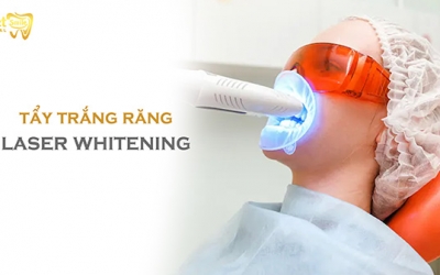 Tại sao tẩy trắng răng Laser Whitening lại được ưa chuộng đến vậy?