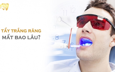 Tẩy trắng răng mất bao lâu thì đem lại hiệu quả tốt nhất?