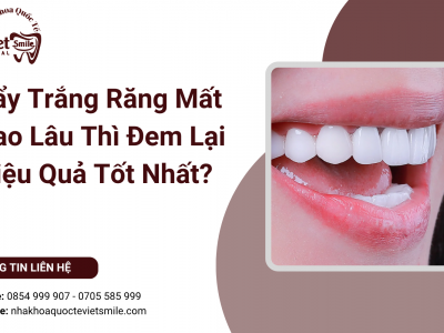 Tẩy Trắng Răng Mất Bao Lâu Thì Đem Lại Hiệu Quả Tốt Nhất?