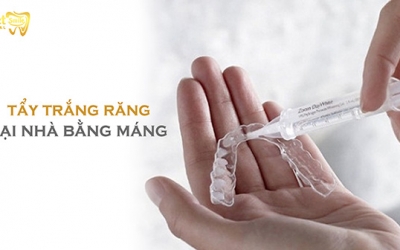 Phương pháp tẩy trắng răng tại nhà bằng máng có thực sự hiệu quả?