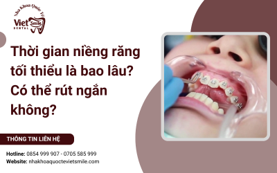 Thời gian niềng răng tối thiểu là bao lâu? Có thể rút ngắn không?