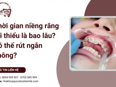 Thời gian niềng răng tối thiểu là bao lâu? Có thể rút ngắn không?