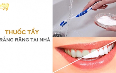 Các loại thuốc tẩy trắng răng tại nhà tốt nhất hiện nay