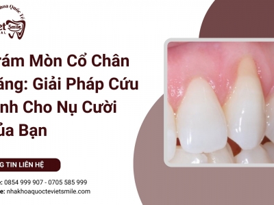 Trám Mòn Cổ Chân Răng: Giải Pháp Cứu Tinh Cho Nụ Cười Của Bạn