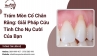 Trám Mòn Cổ Chân Răng: Giải Pháp Cứu Tinh Cho Nụ Cười Của Bạn