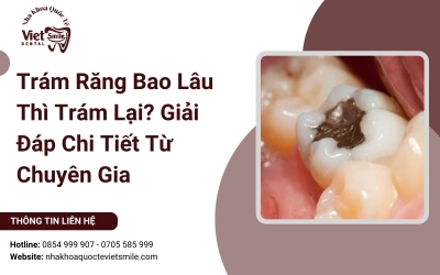 Trám Răng Bao Lâu Thì Trám Lại? Giải Đáp Chi Tiết Từ Chuyên Gia