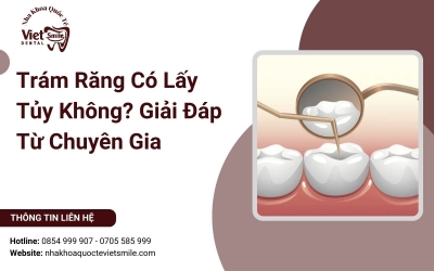 Trám Răng Có Lấy Tủy Không? Giải Đáp Từ Chuyên Gia