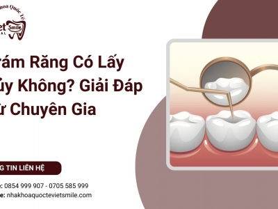 Trám Răng Có Lấy Tủy Không? Giải Đáp Từ Chuyên Gia