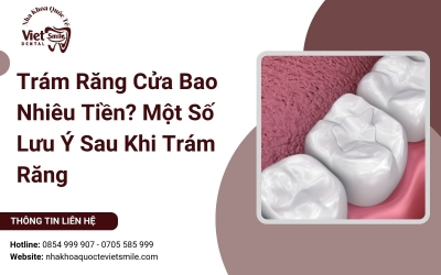 Trám Răng Cửa Bao Nhiêu Tiền? Một Số Lưu Ý Sau Khi Trám Răng