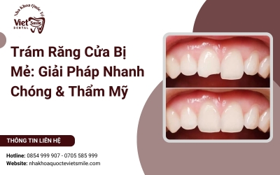 Trám Răng Cửa Bị Mẻ: Giải Pháp Nhanh Chóng & Thẩm Mỹ