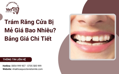 Trám Răng Cửa Bị Mẻ Giá Bao Nhiêu? Bảng Giá Chi Tiết 2025