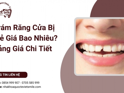 Trám Răng Cửa Bị Mẻ Giá Bao Nhiêu? Bảng Giá Chi Tiết 2025