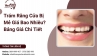 Trám Răng Cửa Bị Mẻ Giá Bao Nhiêu? Bảng Giá Chi Tiết 2025