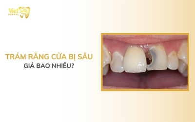 Trám răng cửa bị sâu giá bao nhiêu? Có đau không?