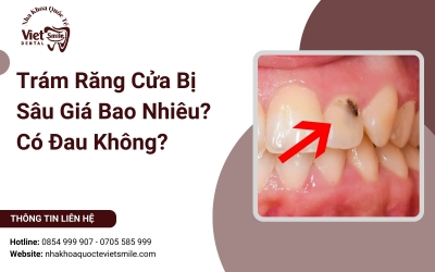 Trám Răng Cửa Bị Sâu Giá Bao Nhiêu? Có Đau Không?