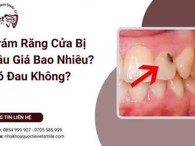 Trám Răng Cửa Bị Sâu Giá Bao Nhiêu? Có Đau Không?