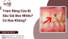 Trám Răng Cửa Bị Sâu Giá Bao Nhiêu? Có Đau Không?