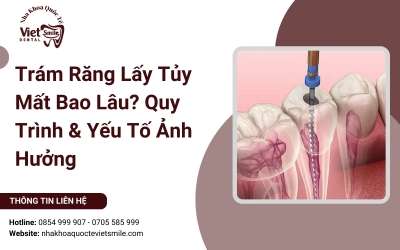 Trám Răng Lấy Tủy Mất Bao Lâu? Quy Trình & Yếu Tố Ảnh Hưởng