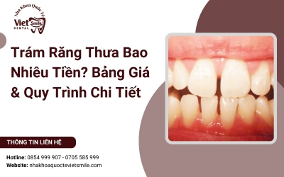 Trám Răng Thưa Bao Nhiêu Tiền? Bảng Giá & Quy Trình Chi Tiết