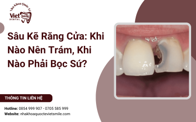Sâu Kẽ Răng Cửa: Khi Nào Nên Trám, Khi Nào Phải Bọc Sứ?