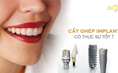 Trồng răng bằng cấy ghép Implant có thật sự tốt không? 5 ưu điểm vượt trội của trồng răng Implant