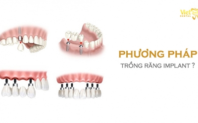 Trồng răng cấy ghép Implant là gì? Những điều bạn nên biết