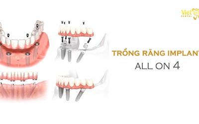 Trồng răng Implant All on 4 là gì? Phương pháp này có ưu điểm và nhược điểm gì?