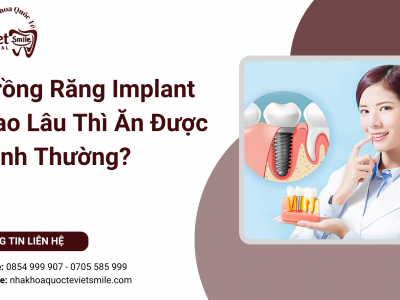 Trồng Răng Implant Bao Lâu Thì Ăn Được Bình Thường?