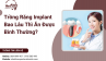Trồng Răng Implant Bao Lâu Thì Ăn Được Bình Thường?