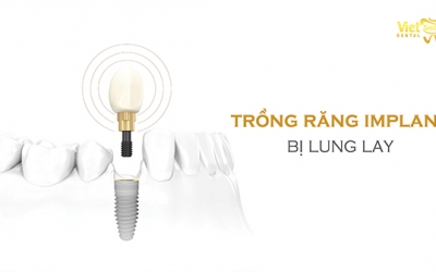 Trồng răng implant bị lung lay thì phải làm sao?