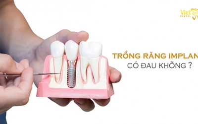 Trồng răng Implant có đau không? Các yếu tố ảnh hưởng đến mức độ đau nhức sau khi trồng răng Implant