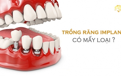 Trồng răng Implant có mấy loại? Đâu là phương pháp trồng răng hiệu quả nhất?